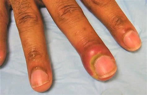 Hangnail & infected hangnail causes, symptoms, diagnosis & treatment