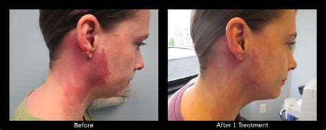 Laser Birthmark Removal: Remove Birthmarks, Port Wine Stains - Connecticut Skin Institute