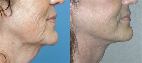 Plastic Surgery Case Study - The Benefits and Longevity of Facelift ...