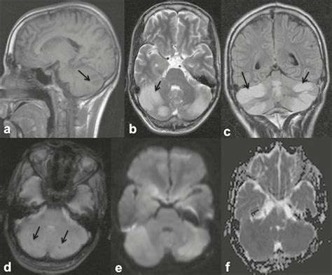 SciELO - Brasil - Spectrum of findings on magnetic resonance imaging of the brain in patients ...