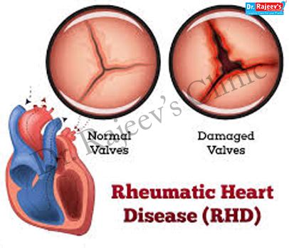 Homeopathic Treatment for Rheumatic Heart Disease, Treatment of ...