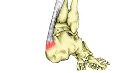 Insertional Achilles Tendonitis - Symptoms, Causes, Treatment & Rehab