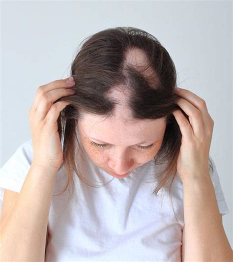 What You Should Know on Alopecia Areata – Hello Med