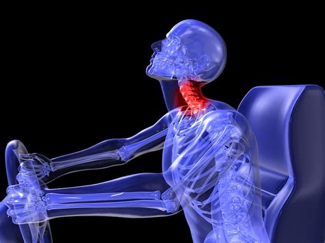 skeleton-with-Whiplash-Injury - Sterling Medical Group