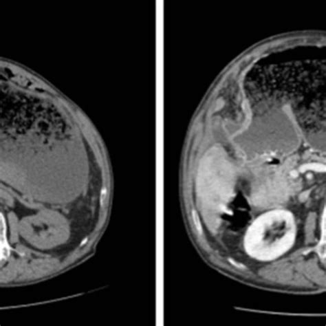 CT examination performed before and after intravenous injection of ...