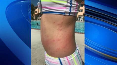 Mom believes sea lice from NC beach caused irritating rash