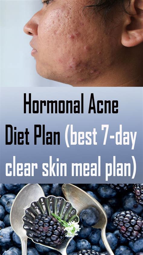 Hormonal Acne Diet Plan (best 7-day clear skin meal plan) | Acne diet plan, Hormonal acne diet ...