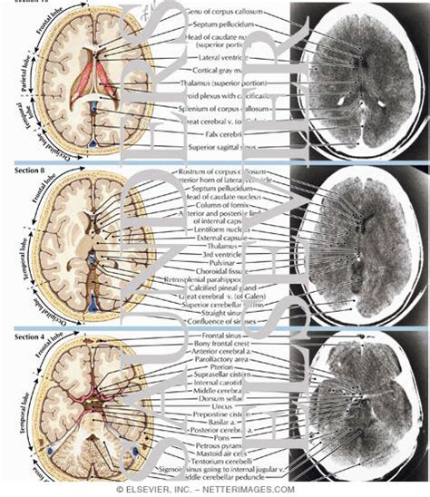 Normal Brain Anatomy as Demonstrated by Computerized Tomography (CT Scanning) | Brain anatomy ...