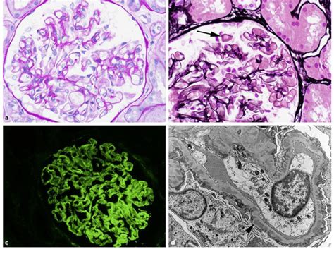 a Pathology of membranous nephropathy. The glomerular basement... | Download Scientific Diagram