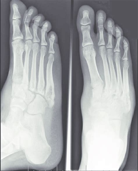 Xray Normal Foot