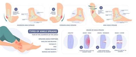 Sprained Ankle: Symptoms, Diagnosis, Physical Therapy