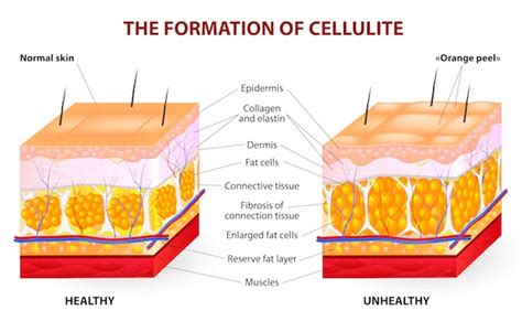 The Reason Why Liposuction Is Not A Treatment For Cellulite - Feel Good ...