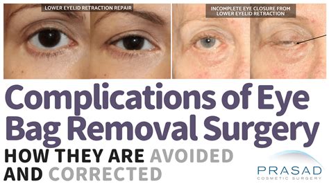 Eye Bag Removal Surgery: Procedure, Risks, Recovery
