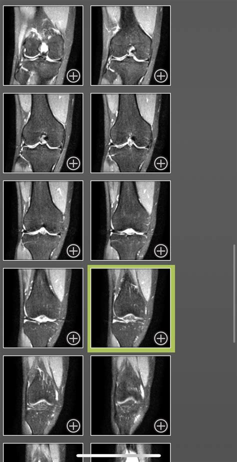 MRI Images : r/ACL