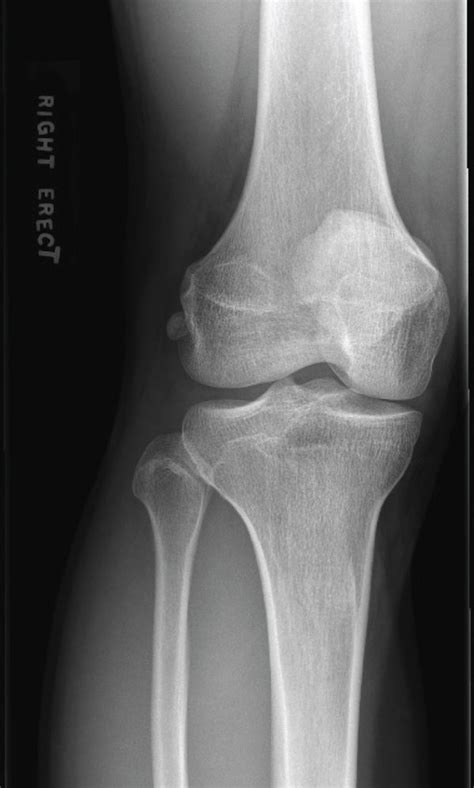 Fabella located lateral out from behind the lateral femur on the AP X ...