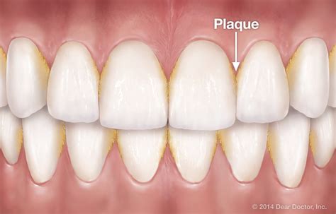 Tartar and plaque removal for a healthy pearly whites. | Dr. Nechupadam Dental Clinic