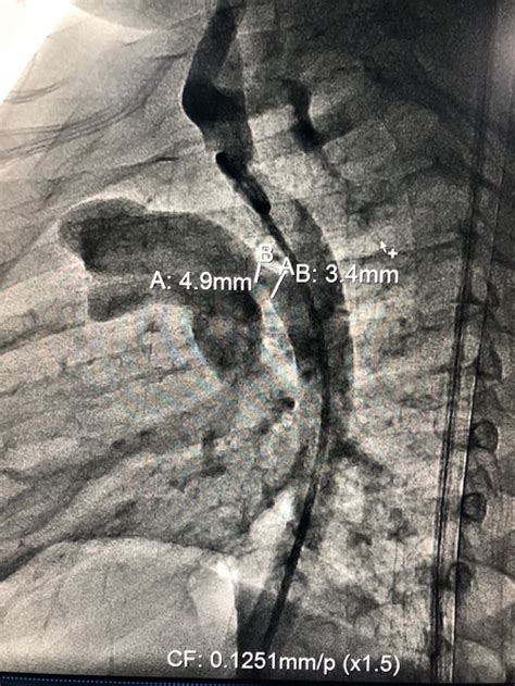 PDA DEVICE CLOSURE DONE ON TWO CHILDREN RECENTLY - Tristate Healthcare ...