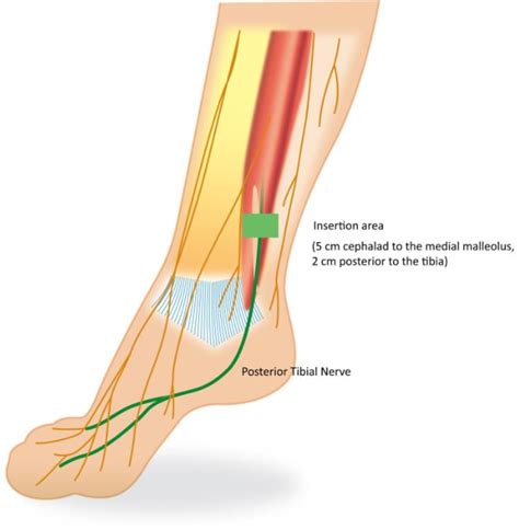 Figure 5 from Management of overactive bladder review: the role of ...