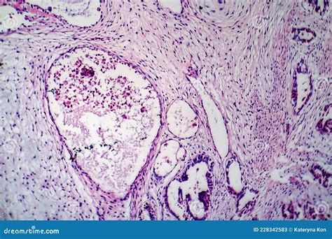 Teratoma, light micrograph stock image. Image of medical - 228342583