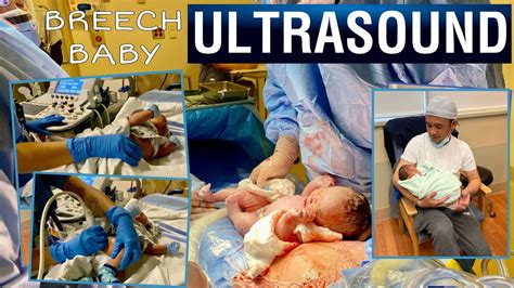 BREECH BABY ULTRASOUND | BUHAY CANADA - YouTube