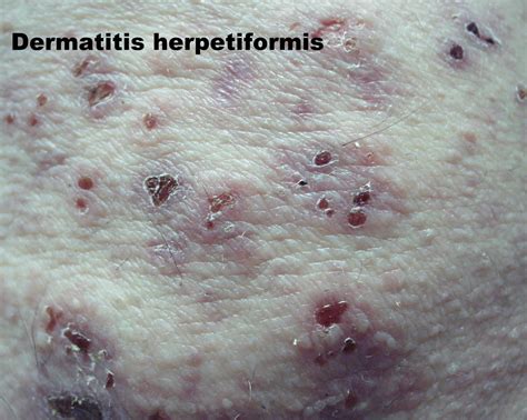 Mild Dermatitis Herpetiformis On Hands