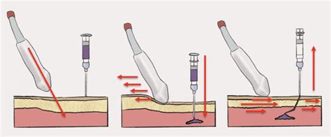 IDEA Series: Just-in-Time Training for Diagnostic Paracentesis – MED-TAC International Corp.