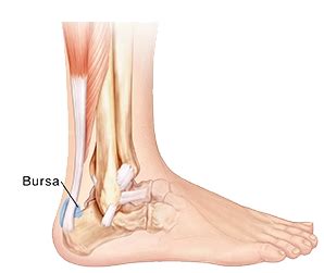 Foot Bursitis Treatment in South Florida | Florida Foot & Ankle