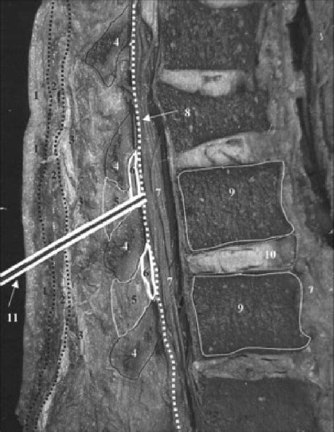 Cadaveric sagittal section through lumbar spine showing proper needle... | Download Scientific ...