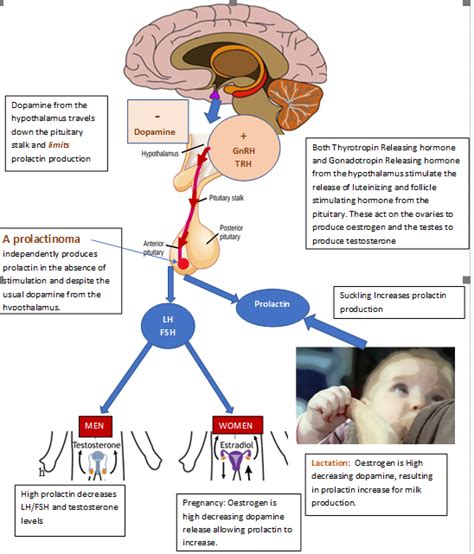 Prolactinoma - WAPO