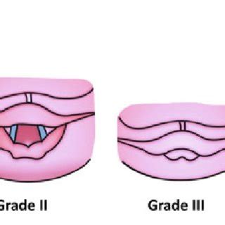 2 Difficult laryngoscopy: Cormack Lehane grading (Grade I–IV) | Download Scientific Diagram