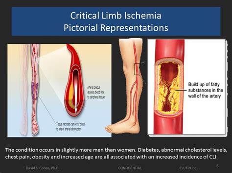 New Treatment: Critical Limb Ischemia (CLI) | EquityNet