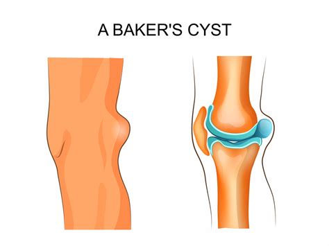 Popliteal Cyst