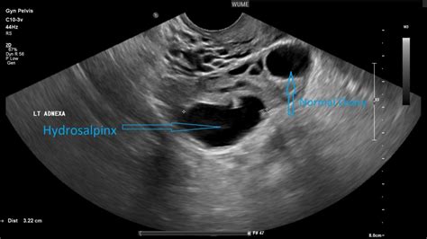 Gynaecology Ultrasound - Women's Ultrasound Melbourne