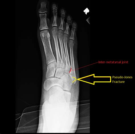 Fifth metatarsal Fractures