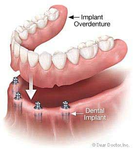 Dental Implant Alternatives: Know Your Options