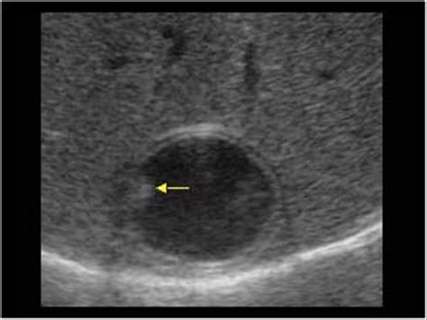 Abdomen and retroperitoneum | 1.1 Liver : Case 1.1.5 Hydatid cysts | Ultrasound Cases