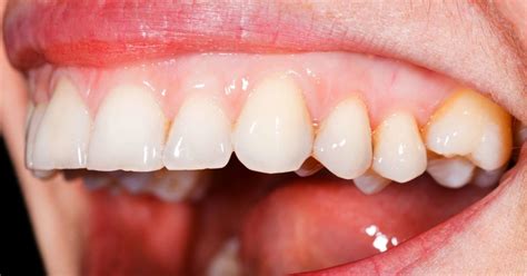 Pale gums: Causes, symptoms, treatment, and warning signs