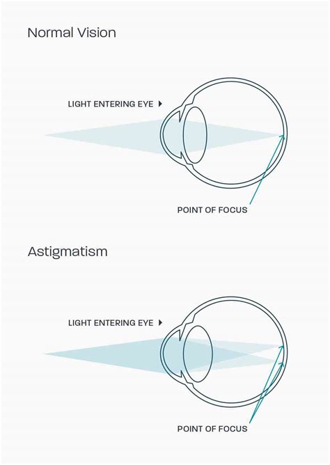 Astigmatism: Causes, Types, Symptoms Treatment, 58% OFF