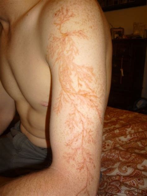 when people are struck by lightening their skin is semi permanently ...