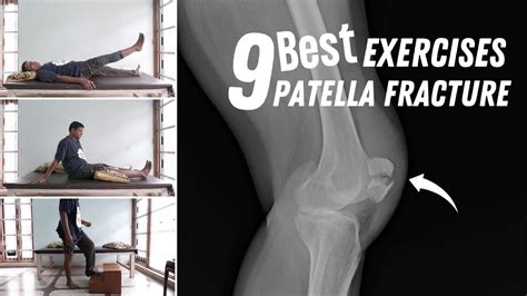 Patella Fracture Exercises