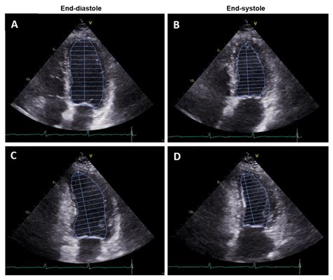 JPM | Free Full-Text | Non-Invasive Assessment of Left Ventricle Ejection Fraction: Where Do We ...