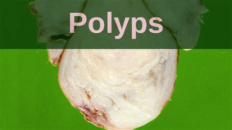 What are Polyps? - Pathology mini tutorial - YouTube