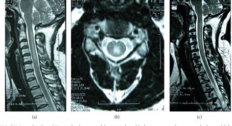 [PDF] Subacute Combined Degeneration of the Spinal Cord due to ...