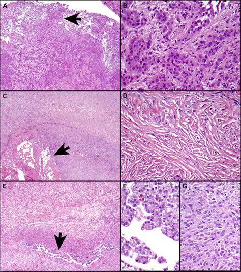 Spindle Cell Tumor Lung Pathology