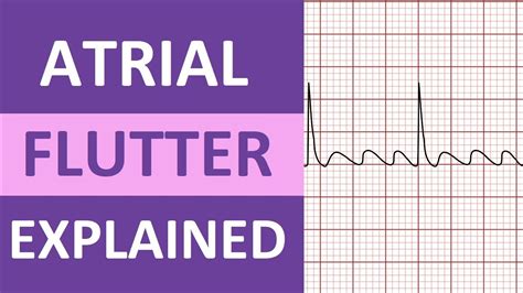 Atrial Flutter Symptoms Ladegdc - vrogue.co