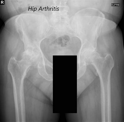 Case Study: Bilateral Hip Replacement in 65 Year Old