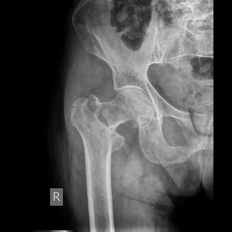 Femoral Neck Fracture