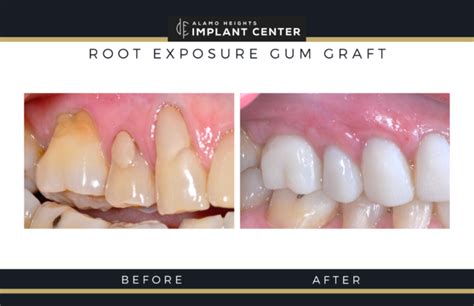 Exposed tooth roots: The “root” of tooth sensitivity in aging – Alamo Heights Implant Center