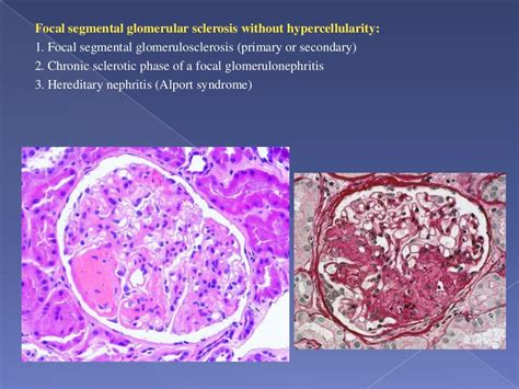 Interpretation of renal biopsy