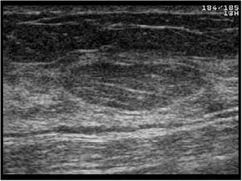 Breast and Axilla | 5.1 Benign lesions : Case 5.1.7 Lipomas | Ultrasound Cases